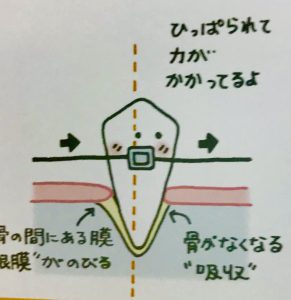 矯正でなぜ歯は動くのか❷
