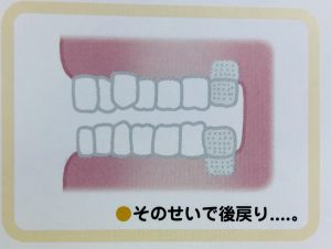 矯正で歯を抜くのはどうして⑤
