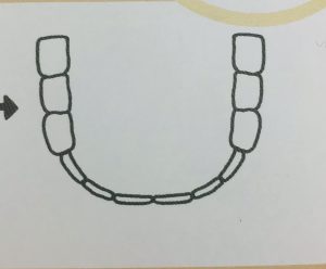 矯正で歯を抜くのはどうして②
