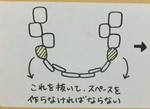 矯正で歯を抜くのはどうして①