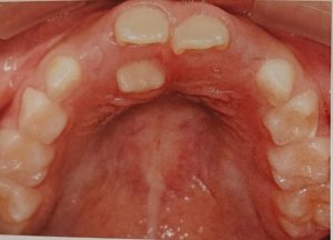 子どもの過剰歯